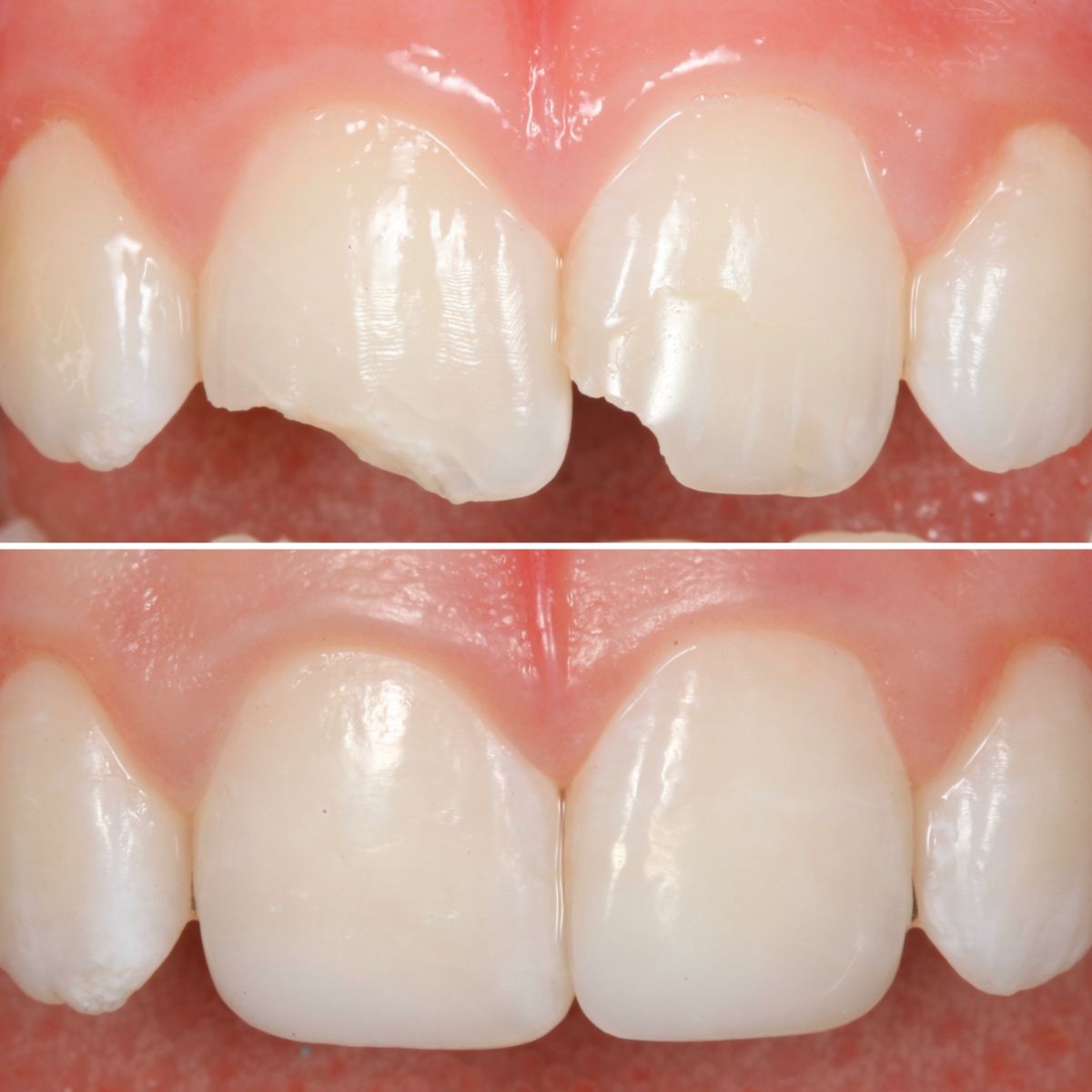 Traumatic Dental Injuries Strupp & Brumm Cosmetic & Restorative